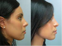 How To Get A Rhinoplasty Covered By Insurance