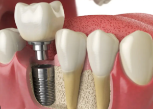 In the realm of modern dentistry, dental implantology stands as a beacon of hope and innovation for those seeking to restore their smiles