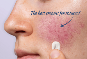 Rosacea Skincare: Selecting the Best Creams for Sensitive Skin