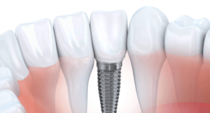 Are Dental Implants Safe? Debunking Common Myths and Misconceptions