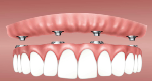 Dental Implants