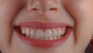 Transforming Smiles in Spearfish: Blauer Family Dental's Expertise