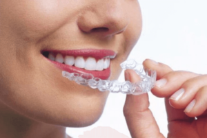 Invisalign Ideal