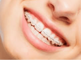 Orthodontic Care: Achieving a Perfect Smile With Braces and Aligners