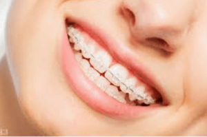 Orthodontic Care: Achieving a Perfect Smile With Braces and Aligners