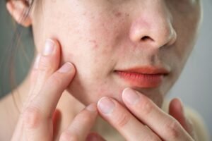 How to Address Fine Lines and Uneven Texture Effectively