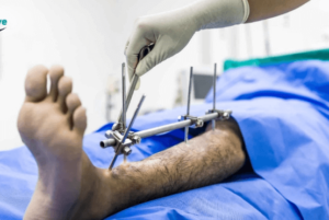 Turkey Leg Lengthening Surgery Cost: Price Per cm Breakdown