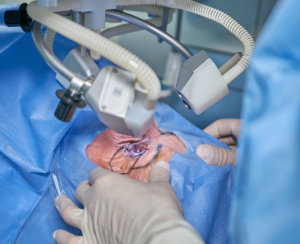 How Does LASIK Surgery Work?