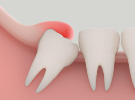 Understanding Tooth Pain: Is It Your Wisdom Teeth or Something Else?