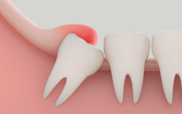 Understanding Tooth Pain: Is It Your Wisdom Teeth or Something Else?