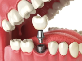Why Bone Density Matters for Dental Implants and How It Affects Cost