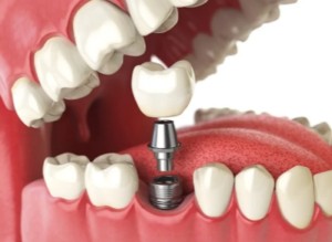 Why Bone Density Matters for Dental Implants and How It Affects Cost