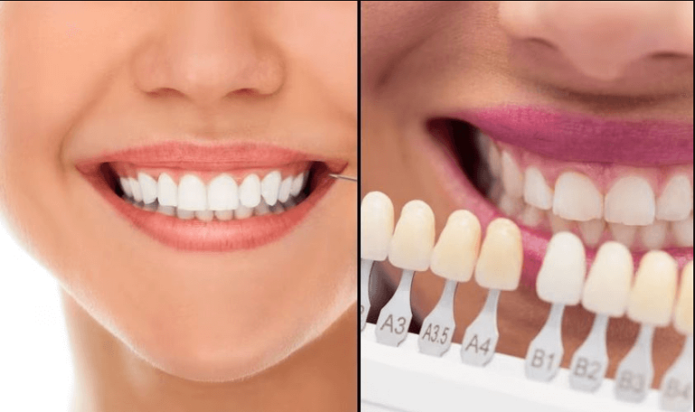 Teeth Whitening Vs Porcelain Veneers: What Is Best for You?