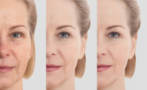 The Emotional Impact of Facial Aging and Self-Perception